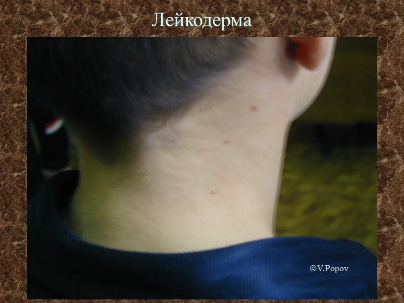 Лейкодерма г V.Popov